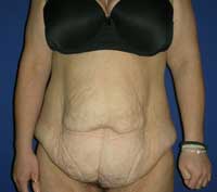 χαλάρωση δέρματος κοιλιάς μετά απώλεια 130 κιλών-κοιλιοπλαστική